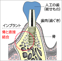 インプラントとは