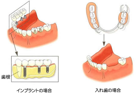 入れ歯