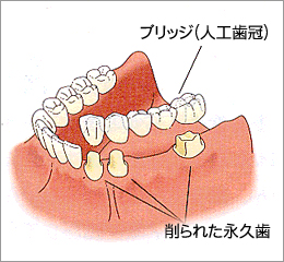 当クリニックのブリッジ治療